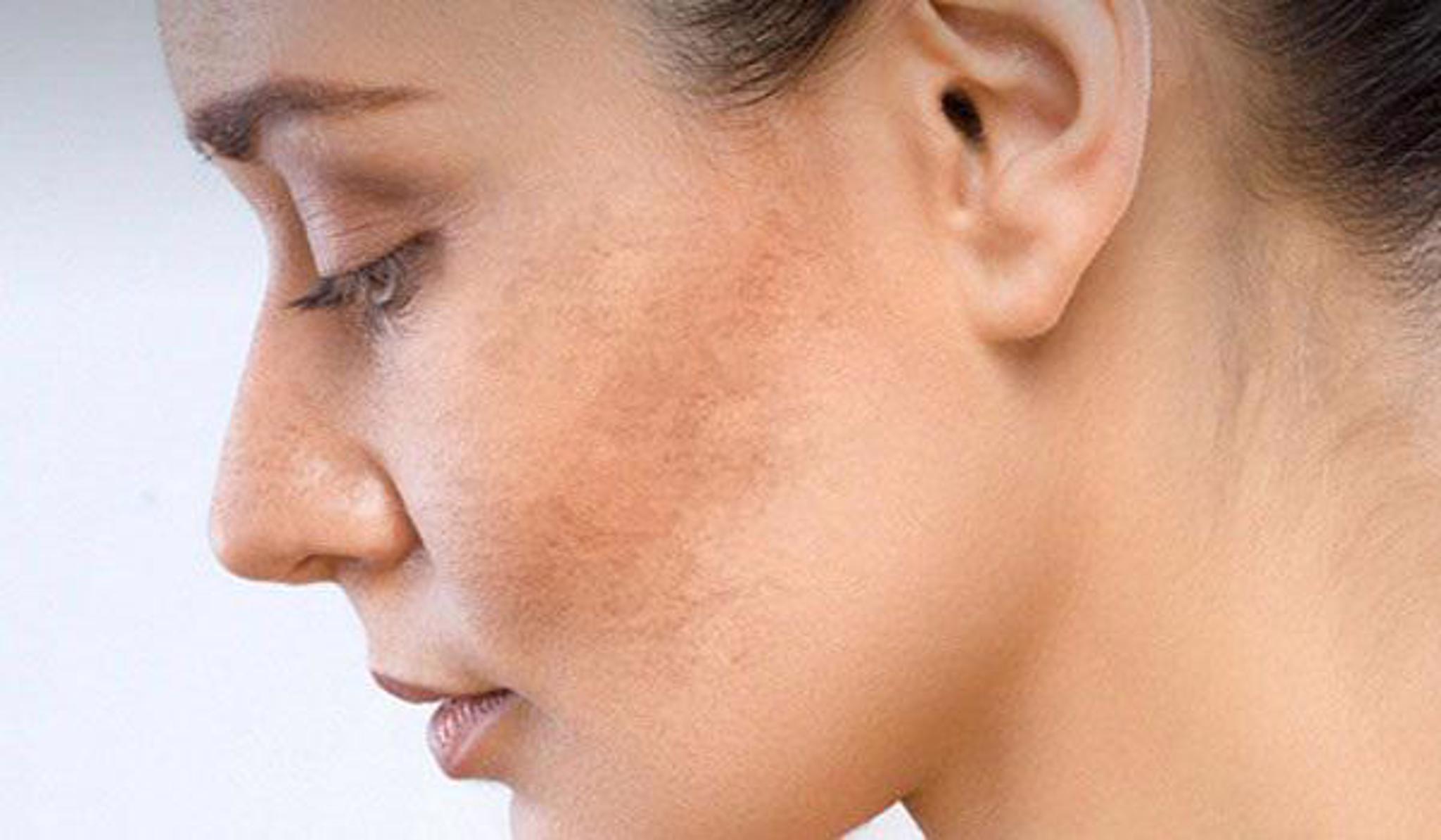 Da mặt lốm đốm tàn nhang sau sinh – Mách chị em cách cải thiện hiệu quả từ thảo dược